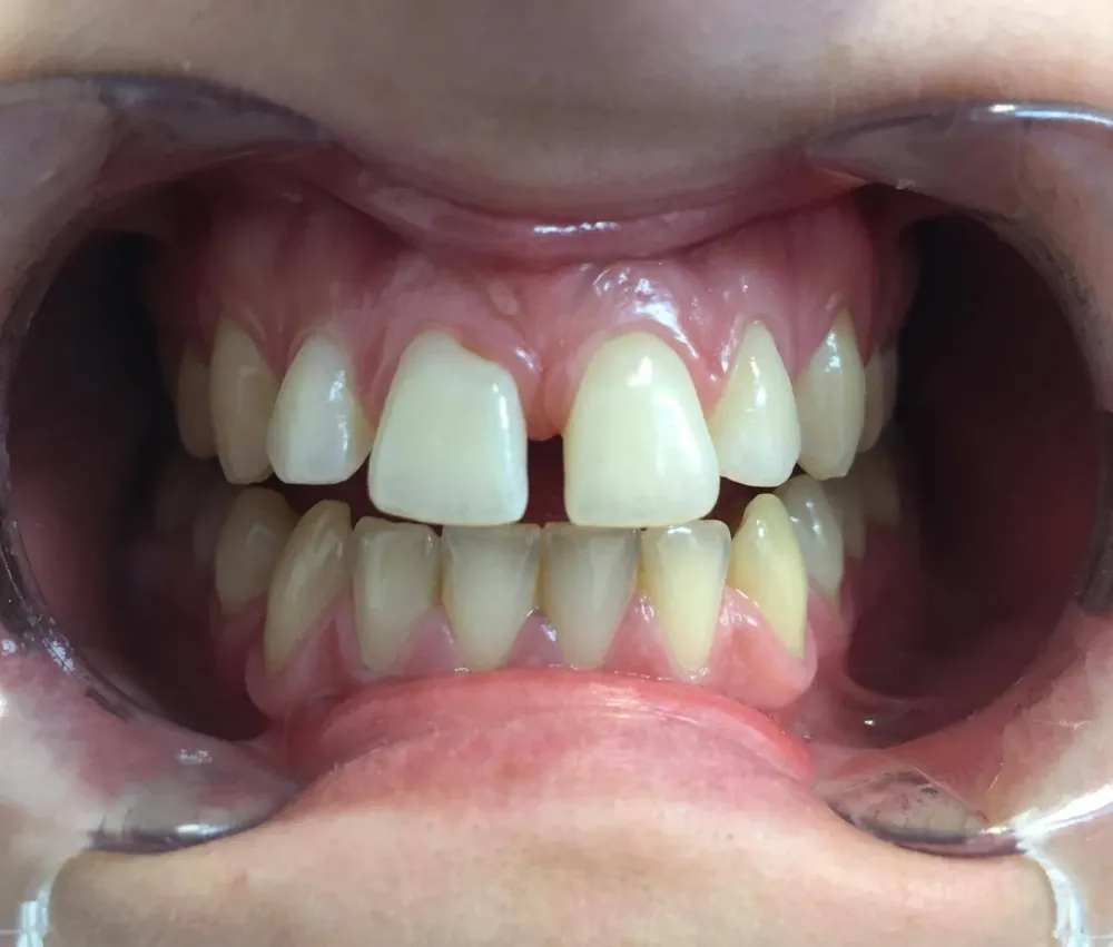 facettes dr brezel (6)