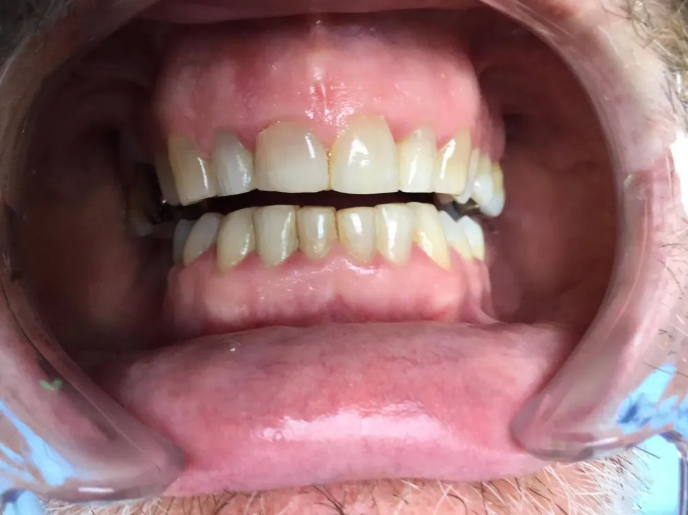 facettes dr brezel (8)