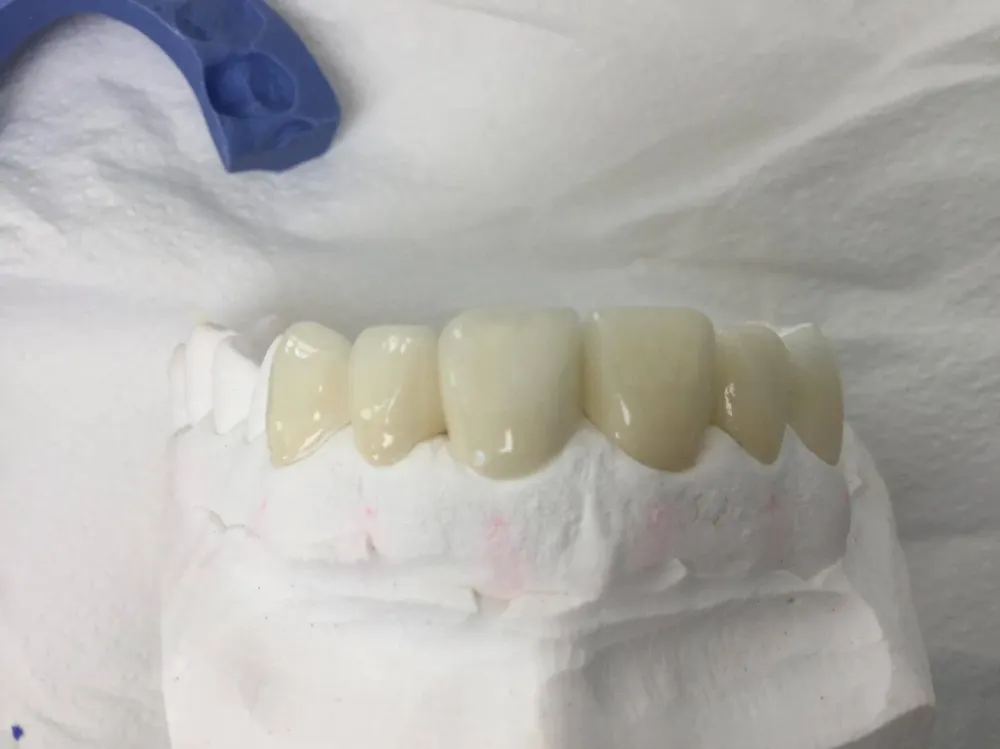facettes dr brezel (1)