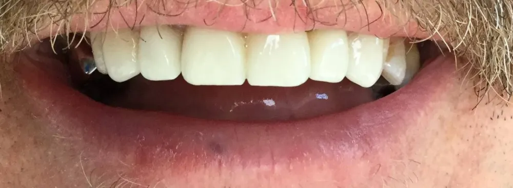 facettes dr brezel (2)
