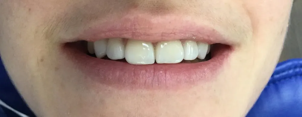 facettes dr brezel (3)