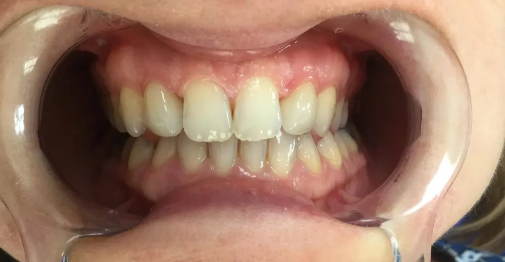 facettes dr brezel (4)