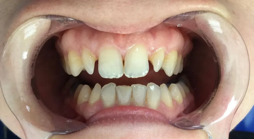 facettes dr brezel (5)