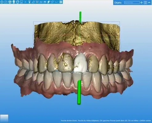 chirurgie guidee (3)