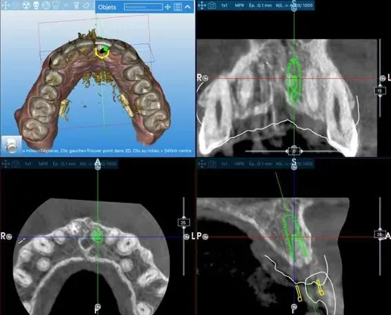 chirurgie guidee (4)