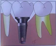 Implantation dentaire (2)