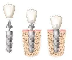 Implantation dentaire (3)